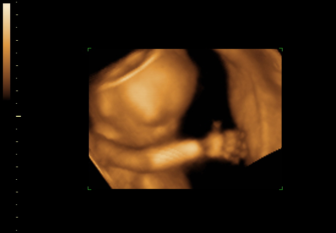 3D ultrasound image at 17 weeks